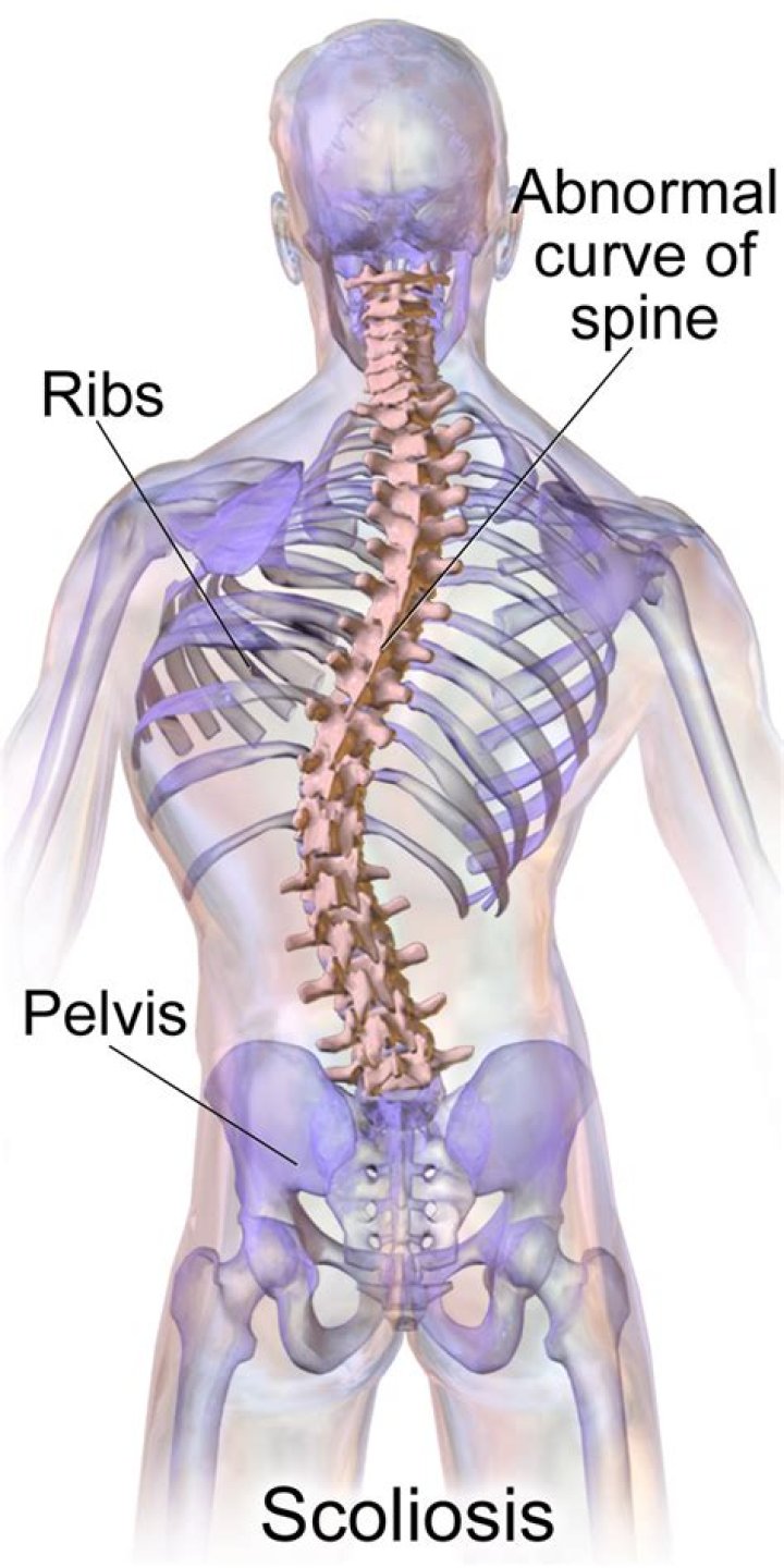 Can a heavy backpack cause scoliosis?