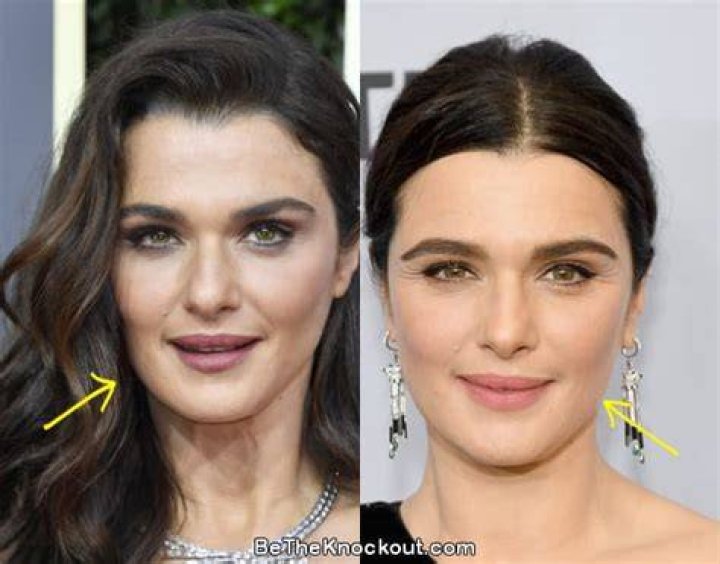 Rachel Weisz Facelift Plastic Surgery Before and After