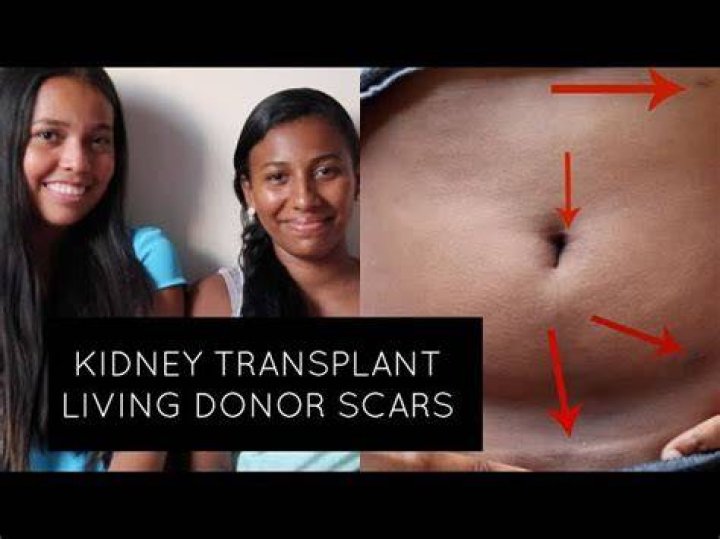 Unlocking The Secrets Of Scar Kidney Transplant: Discoveries That Transform Lives